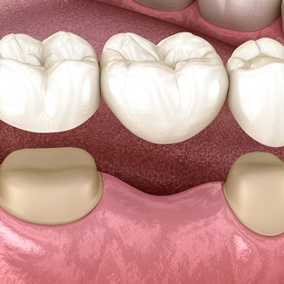 A digital image of a dental bridge going on over health teeth located on the lower arch of a person’s smile