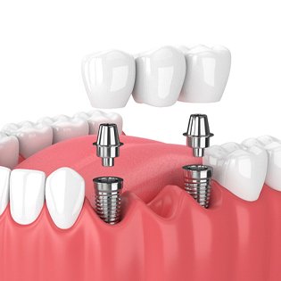 An image of a dental implant bridge with the abutment and custom restoration